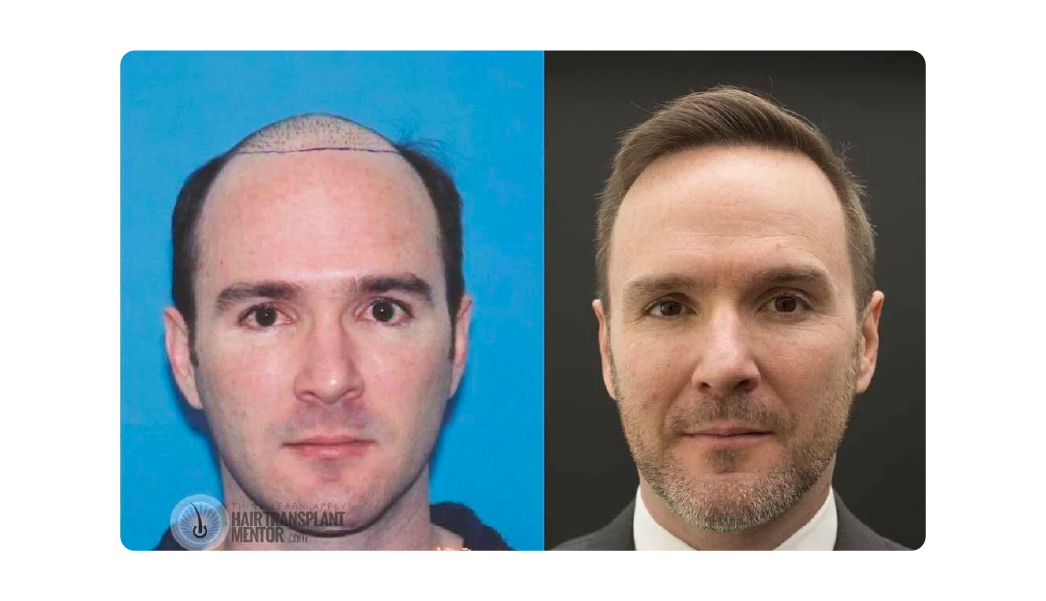 Joe Tillman, co-host of The Bald Truth and Rootique Global Brand Ambassador, hair restoration expert with 24 years in the industry